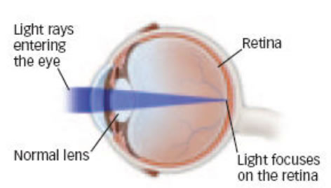 cataracts1