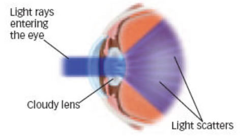 cataracts2