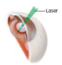 cataracts6